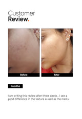 Minimalist AHA PHA BHA 32% Face Peel - 5